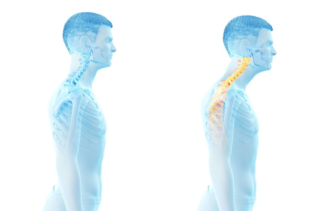 Was ist Forward Head Posture?
